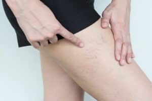 Close up of a patient pointing at the spider veins on her thighs