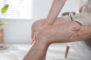 Woman with her heels kicked off, rubbing at the varicose veins on her calves